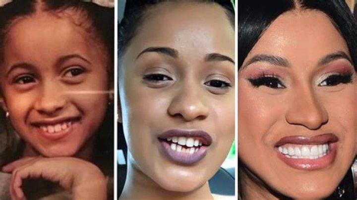 Cardi B's Amazing Transformation: Before And After Veneers