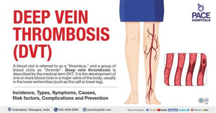 ICD-10 Codes For Deep Vein Thrombosis In The Lower Extremity