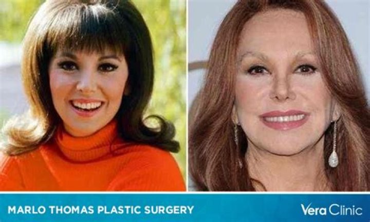 Marlo Thomas' Plastic Surgery: Unveiling The Truth About Facial Enhancements