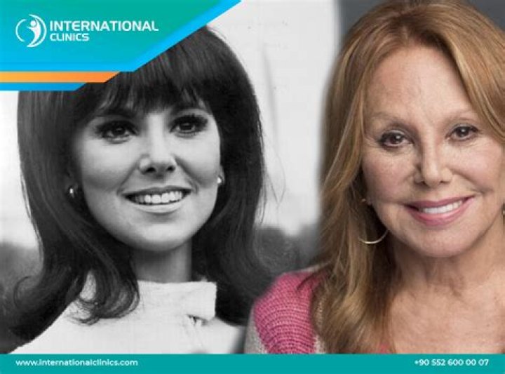Marlo Thomas Nose: Revealing The Truth Behind The Speculations