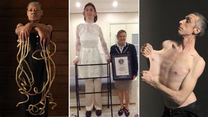 Meet The Incredibly Thin "World's Skinniest Person"