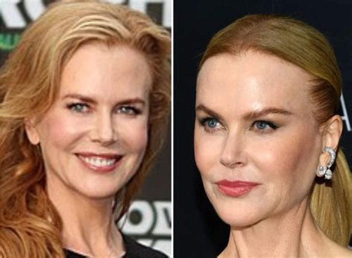 Nicole Kidman Plastic Surgery: Unveiling The Truth Behind The Speculations
