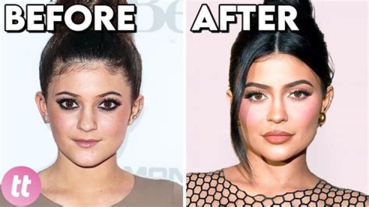 Paris Hilton's Surprising Plastic Surgery Journey: Before And After Photos