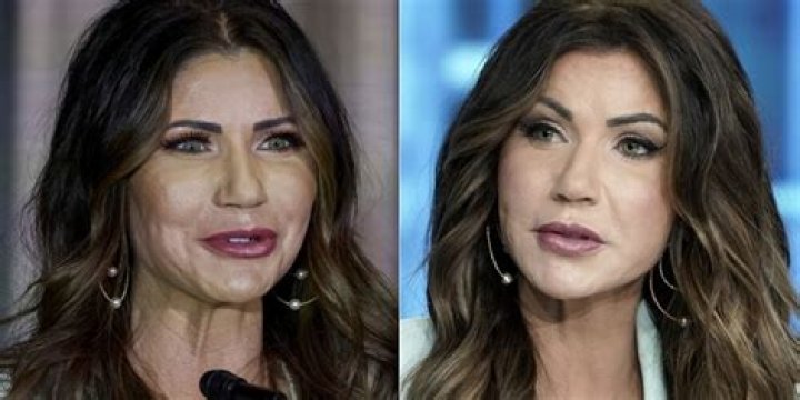 The Ultimate Guide To Kristi Noem's Plastic Surgery Allegations