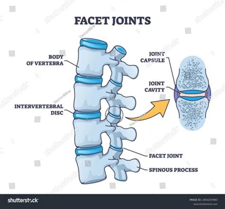 The Ultimate Guide To Understanding Facet Hypertrophy: Definition And Causes