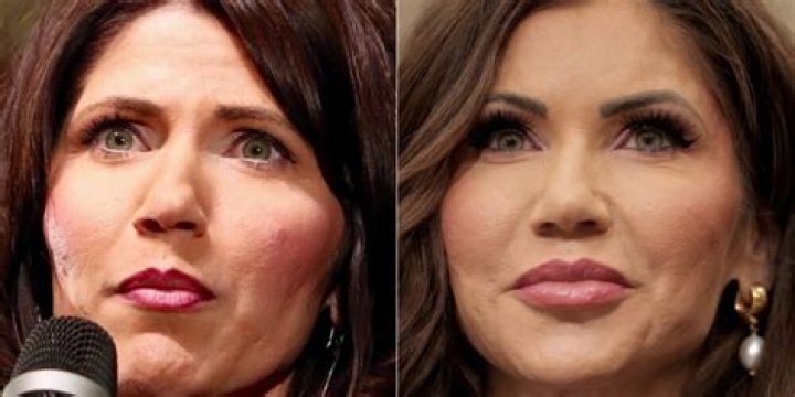 Unveiling The Truth Behind Kristi Noem's Plastic Surgery
