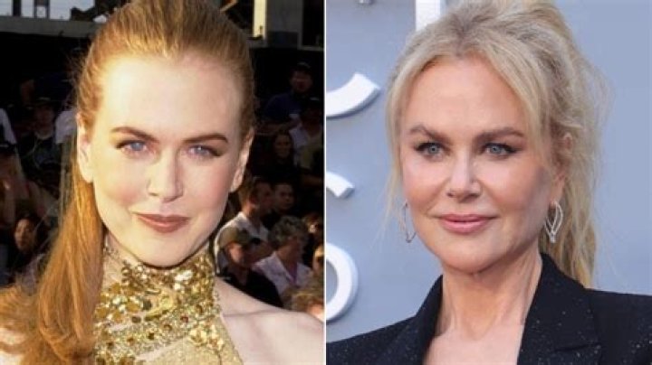 Witness Nicole Kidman's Face Surgery Transformation